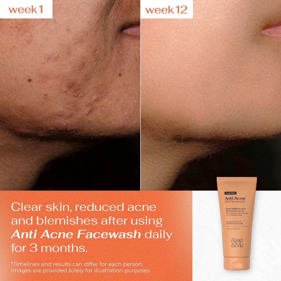 Anti Acne Gel Face Wash