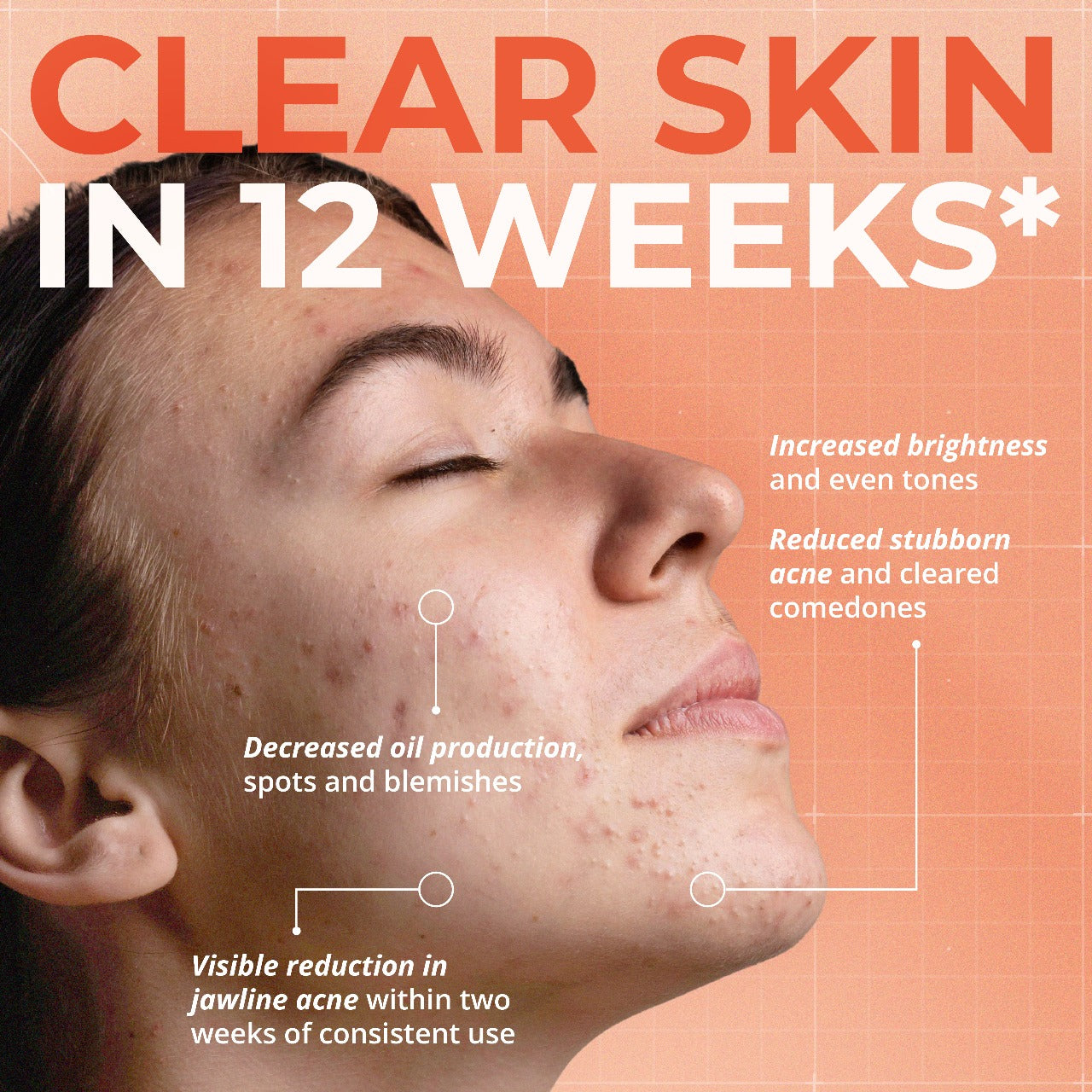 3-Step Anti Acne Kit