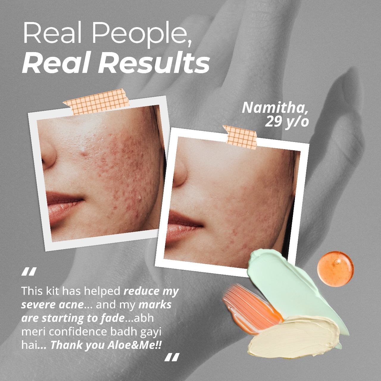 3-Step Anti Acne Kit