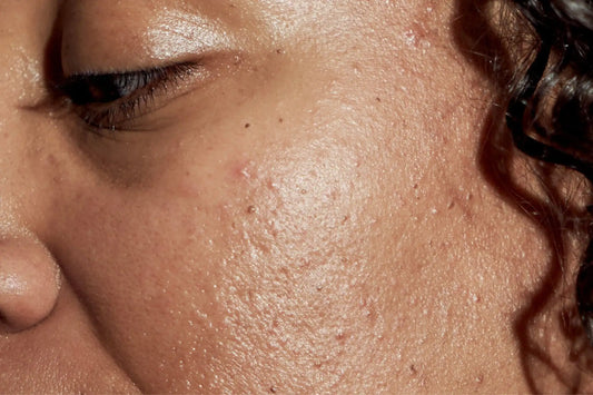 How to Reduce Acne Fast at Home (Simple Routine That Works)