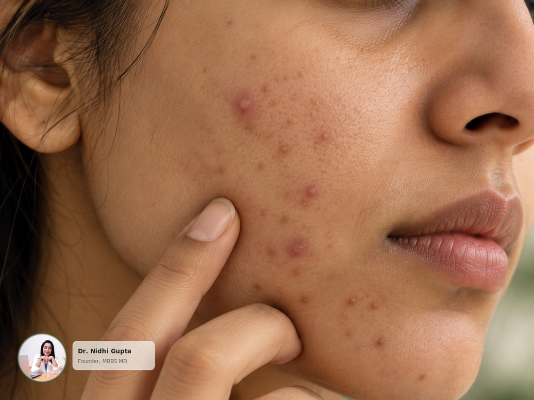 What Causes Acne? 7 Common Causes Explained by a Dermatologist