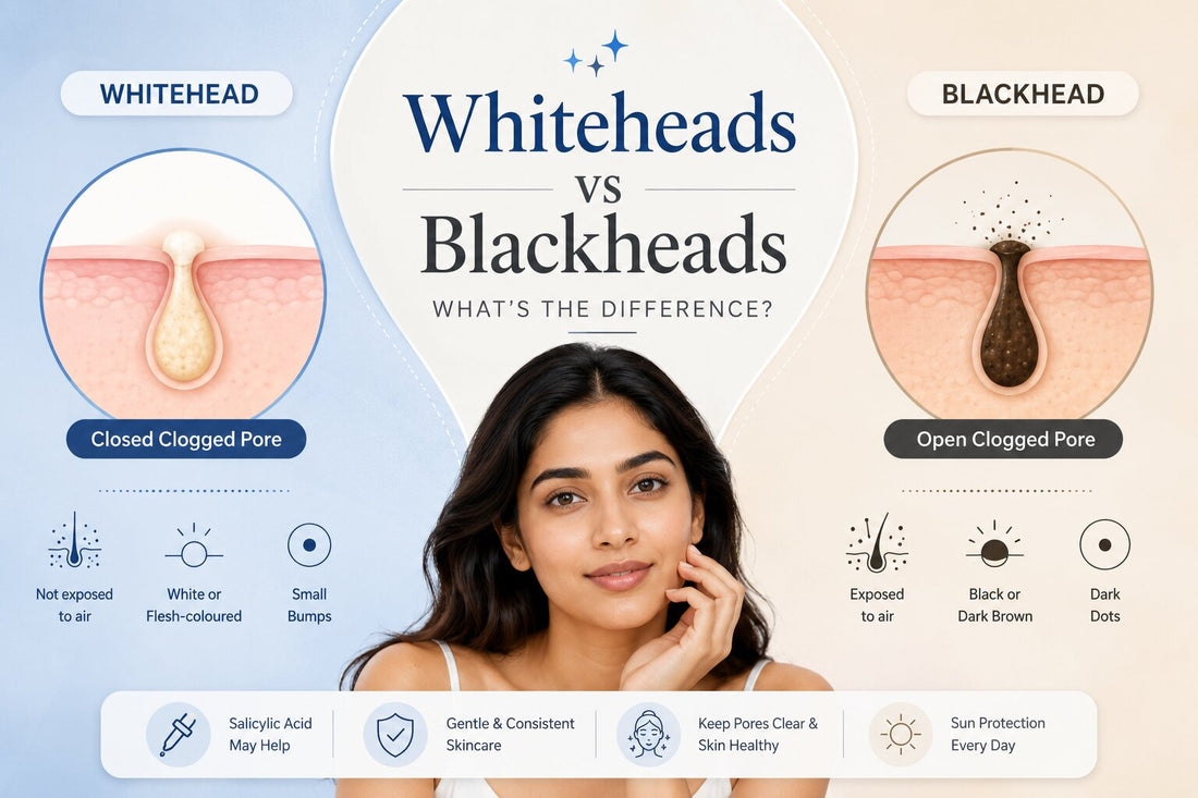 Whiteheads vs blackheads comparison guide showing pore diagrams and dermatologist-approved information about clogged pores and acne lesions.