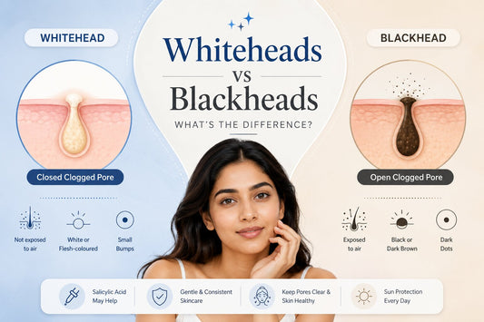 Whiteheads vs blackheads comparison guide showing pore diagrams and dermatologist-approved information about clogged pores and acne lesions.