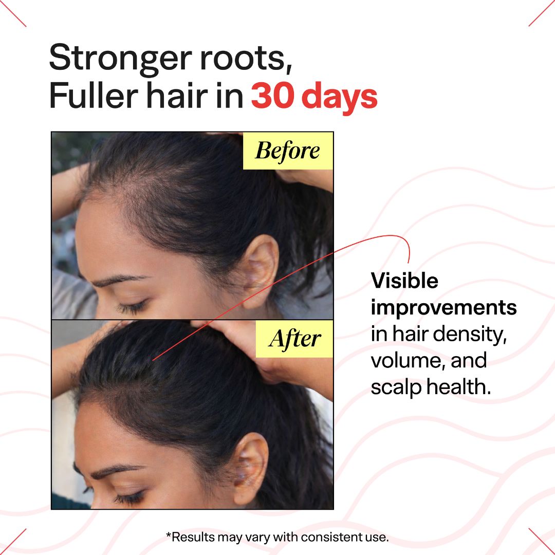 Advanced Daily Hairfall Kit with Hairfuel | Complete Hair Fall Treatment System