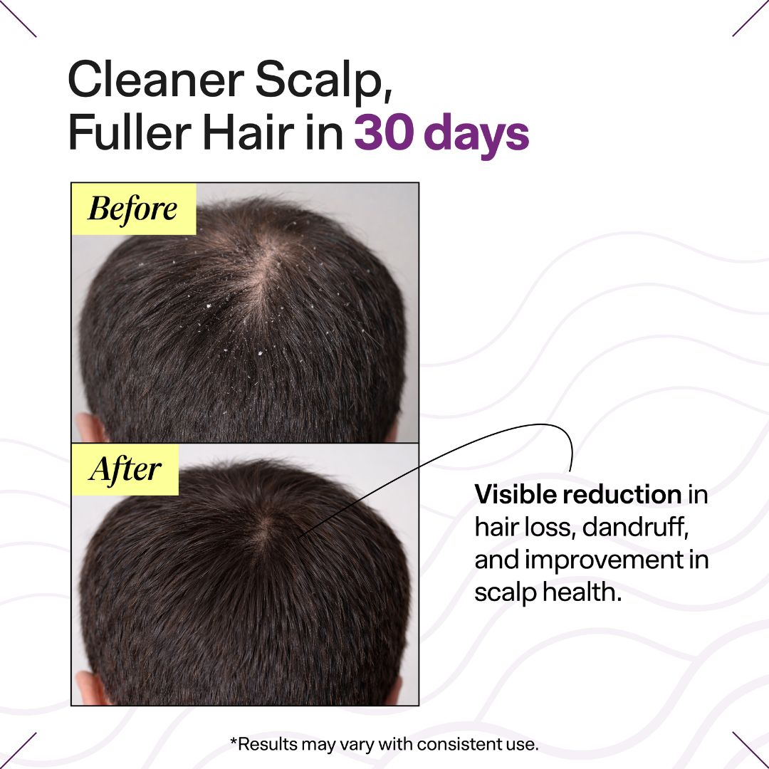 Oil Control Hairfall Kit for Oily Scalp | Hair Fall Treatment Routine