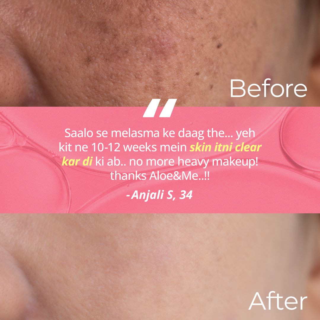 Advanced Melasma Kit