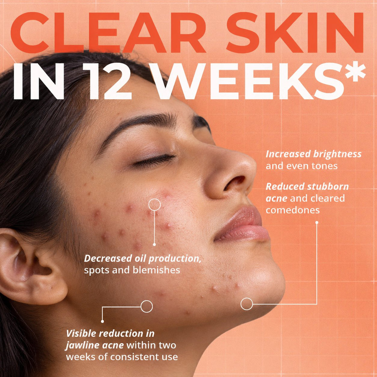 Indian woman with acne-prone skin in a close-up profile, with text highlighting clearer skin in 12 weeks, reduced acne and comedones, decreased oil production, brighter even skin tone, and reduced jawline acne.